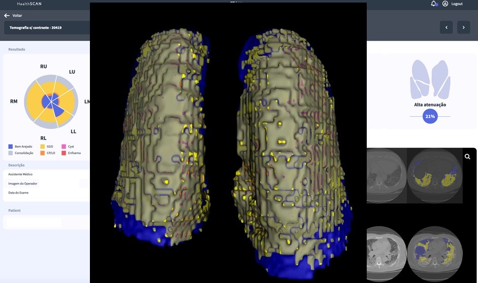 Plataforma CovidScan em ação na análise de tomografia